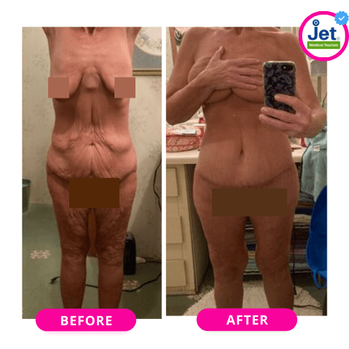 Tummy Tuck Before and After