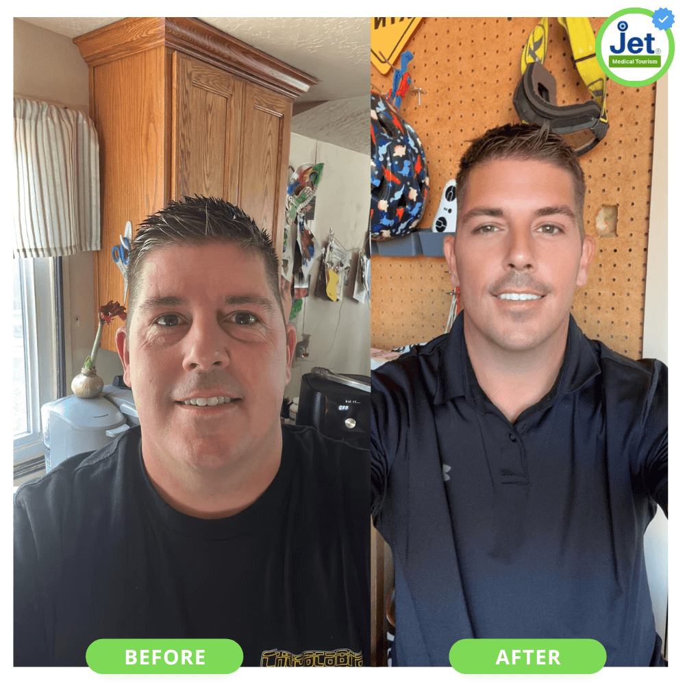gastric bypass before and after in tijuana