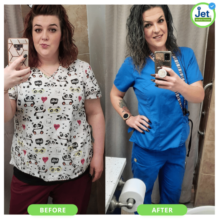 Gastric Bypass Before and After Pictures and Photos 2025