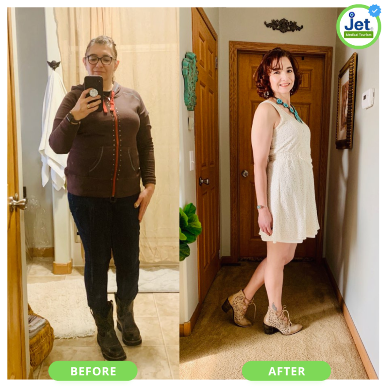 Gastric Bypass Before and After Pictures and Photos 2025